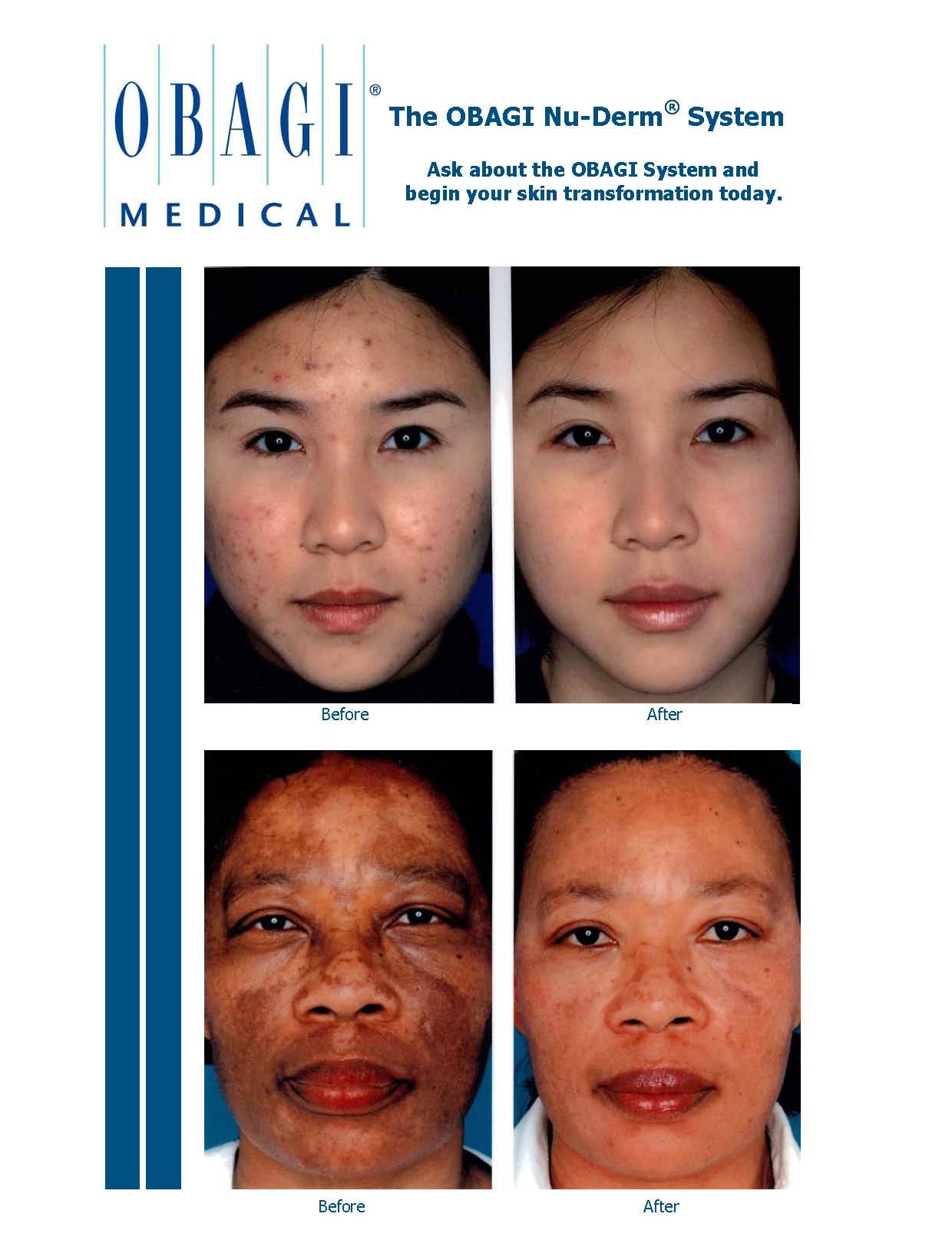 Obagi Skin Care Before After Photos